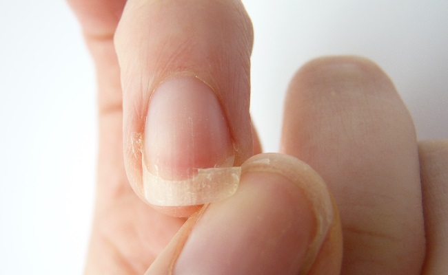 Mały, wielki kłopot – łamliwe paznokcie